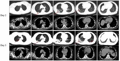 Case Report: Pirfenidone in the Treatment of Post-COVID-19 Pulmonary Fibrosis